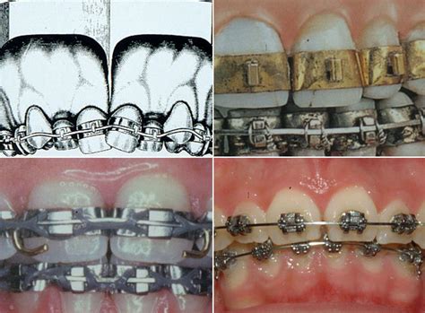 brackets metalicos antiguos|brackets de ortodoncia.